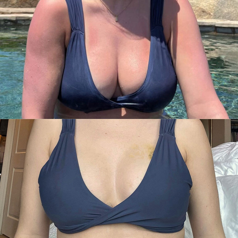 patient selfie before&after